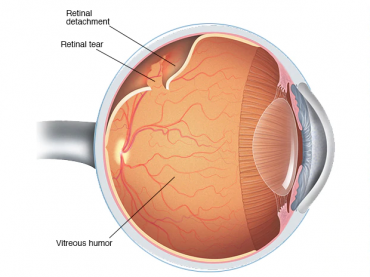 Retina Dekolmanı Tedavisi